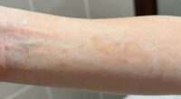 detecting tanning overexposure signs
