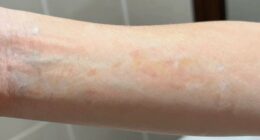 detecting tanning overexposure signs