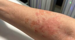 indoor tanning health risks