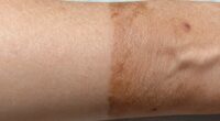 indoor tanning skin effects