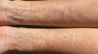 melanin increases with uv