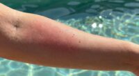 pool chemicals cause skin irritation