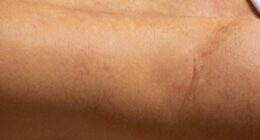 skin damage from tanning