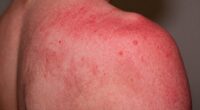skin reaction from tanning