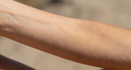 sunbed use alters skin tone