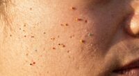 sunlight alters skin bacteria