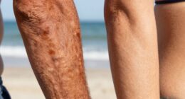 tanning harms skin health