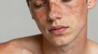 uneven skin pigmentation