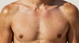 uneven tanning body areas