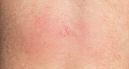 uv rays cause skin inflammation